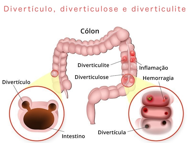 Diverculite e Diverculose: qual a diferença?